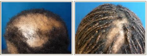 Are you experiencing hair loss, thinning or a receding hairline? How to Regrow Hair for Black Women!