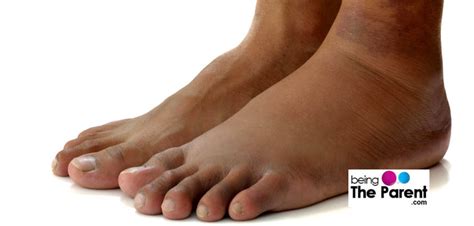 Swollen Ankles In Pregnancy Causes And Remedies Being The Parent