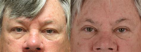 Eyelid Surgery Blepharoplasty Before And After Pictures Case 14