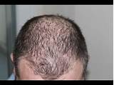 Images of Psoriasis On Your Scalp Treatment