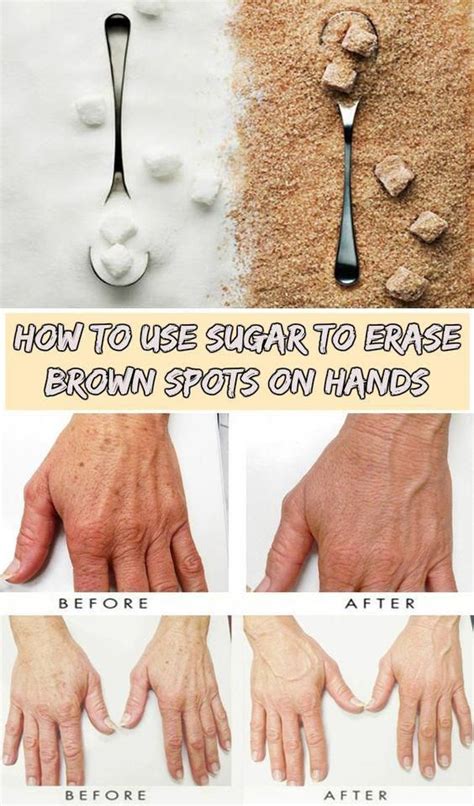 Ways To Get Rid Of Brown Spots On Facial Area Brownspotsonhands