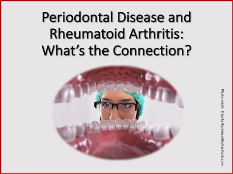The Link Between Periodontal Disease And Rheumatoid Arthritis