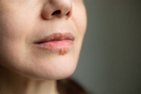 Why Are Cold Sores More Common In Winter And How Do You Tackle Them