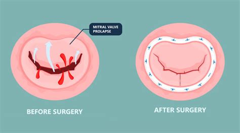 Mitral Valve Repair Different Approaches For Patients