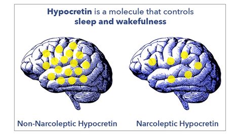 Narcolepsy And Hypocretin Cause And Treatment