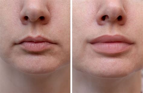 4 Most Popular Lip Fillers That Make Your Pout Last Really Long