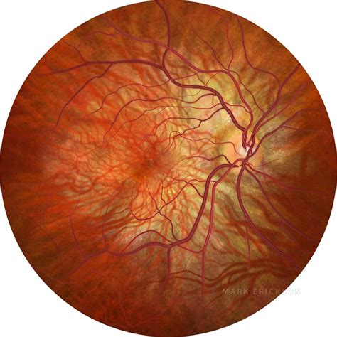 Leber Congenital Amaurosis Retinal Dystrophy Fundus Perspective