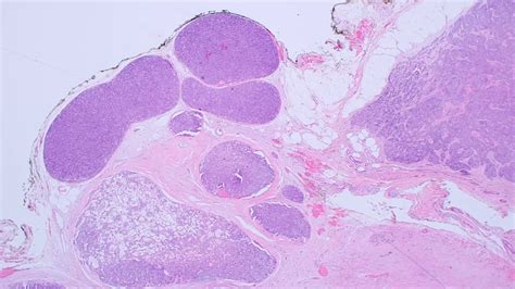 Spiradenoma And Cylindroma 101 Videosweat Gland Tumor Pathology