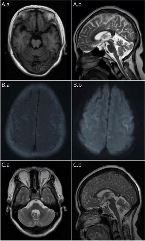 Abnormal Brain Mri Results