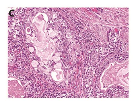 Histopathological Findings Of The Parotid Gland Mass A A Low Power