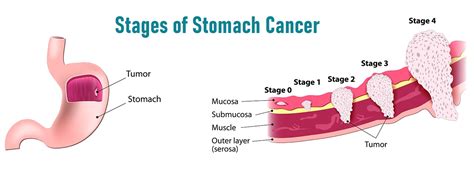 Stomach Cancer Stages