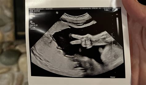 Gestation Of Fetus In Ultrasound Photo Surprises Parents Weve Never