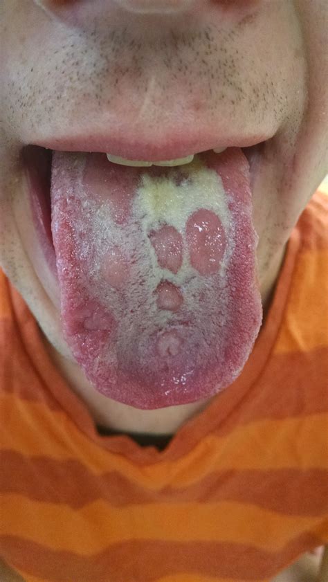 Syphilis Image Of Lesions Of Secondary Syphilis