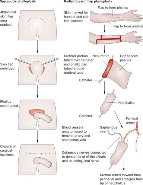 Figure 2 Gender Reassignment Surgery An Overview Nature Reviews