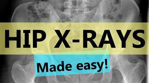 How To Read Hip X Rays Easy Guide Youtube
