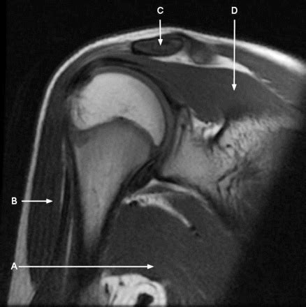 Coronal Oblique Proton Density Weighted Magnetic Resonance Imaging Of The Right Shoulder The BMJ