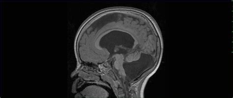 Dandy Walker Malformation Neuro Mr Case Studies Ctisus Ct Scanning