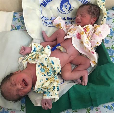 mum miraculously gives birth naturally to conjoined twins attached at the abdomen mirror online