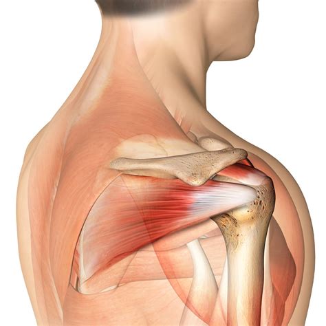 Rotator Cuff Tears Diagnosis Symptoms And Treatment