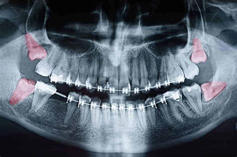 Trusted Wisdom Teeth Extraction Dentist Serving Fort Lauderdale