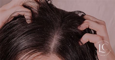 Dermatite seborreica no couro cabeludo conheça as causas e tratamentos