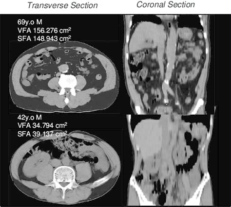Representative Mdct Images Used For Determination Of Visceral Fat Area