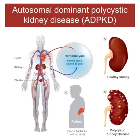 Adpkd Outcomes Differ By Race Renal And Urology News