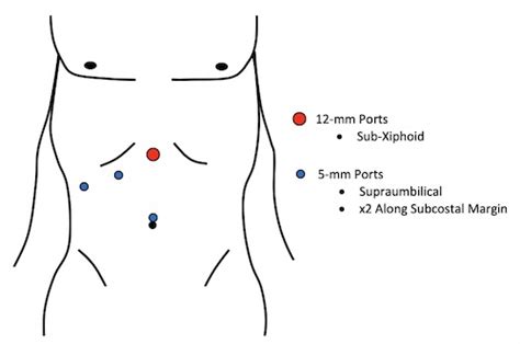 Laparoscopic Cholecystectomy Ports