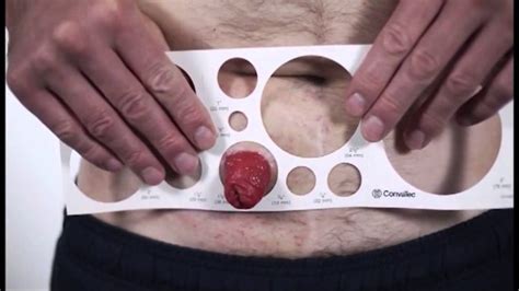Measuring How To Size Your Stoma Youtube