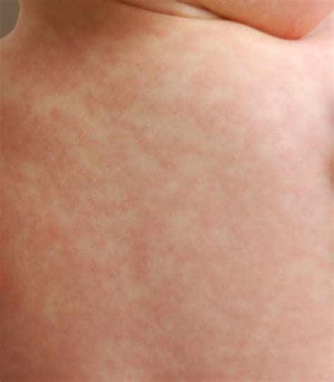 Fileamoxicillin Rash 26 Hours After 17th Dose Wikimedia Commons
