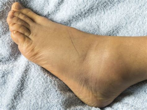 Here Are Six Causes Of Swollen Ankles And Three Ways To Treat Them Fleekloaded