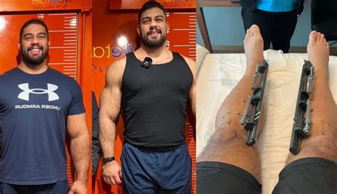Turkey Leg Lengthening Surgery Georgia Man Has Surgery To Make Himself Inches Taller