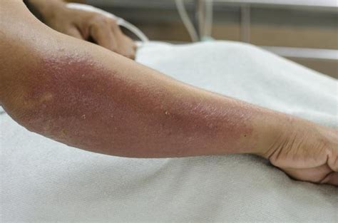 Causes Of A Red Rash On My Arm Livestrongcom