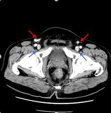 Ct On August 1 2017 Shows The Enlarged Inguinal Lymph Nodes Red
