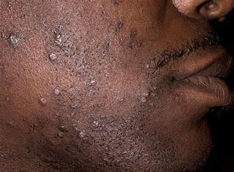 What Causes Pimples After Shaving Beards And How You Can Prevent It