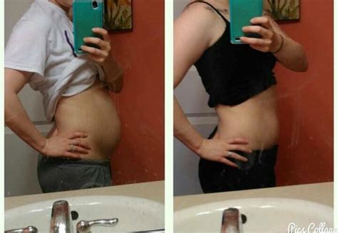 Endometriosis Belly Wearing Maternity Clothes For Stomach Swelling