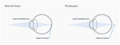 Can Presbyope Wear Contact Lenses Evershine Optical