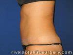 The Woodlands Tummy Tuck Abdominoplasty Before And After Photos