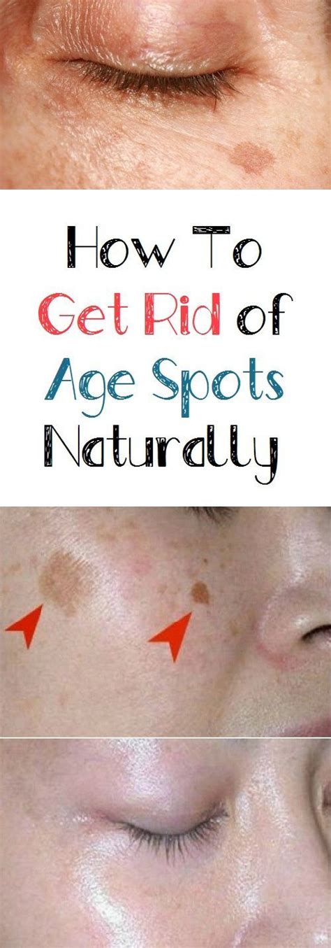 How To Get Rid Of Age Spots Naturally Brown Spots On Skin Age Spots Spots On Face