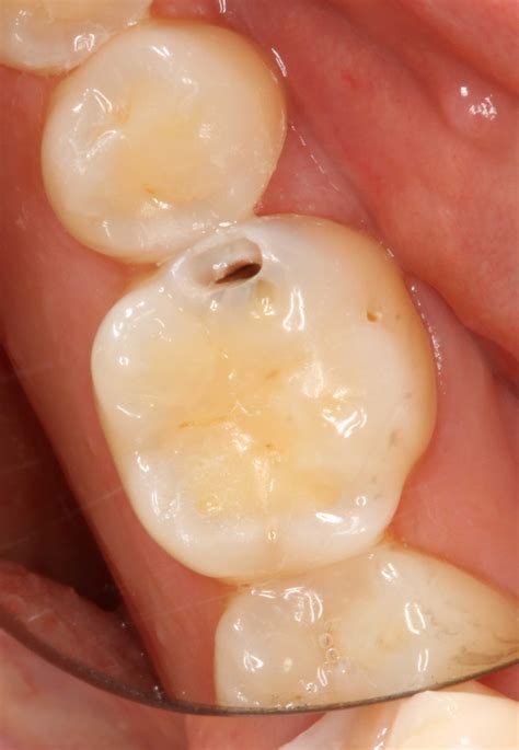 Initialkaries bezeichnet man auch oft als kreideflecken. Zahnzwischenraumkaries | Zahnnotizen