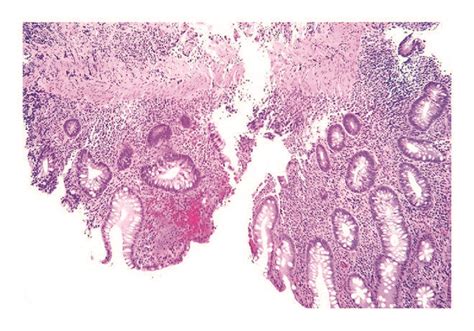 Biopsy Of Rectum Shows Chronic Active Colitis Histopathology And