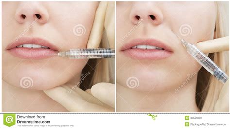 La Femme Obtient Une Injection Dans Son Visage Collage Image Stock Image Du Pointeau