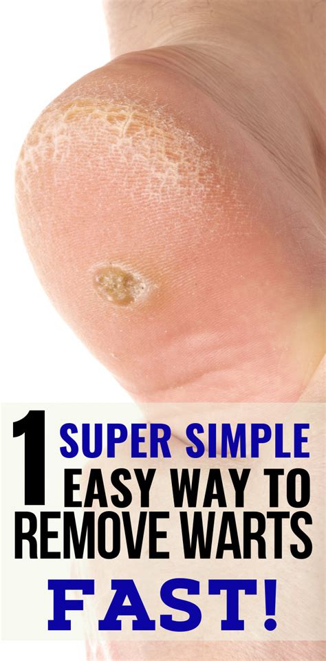 The Easiest Way To Get Rid Of Warts Naturally Home Remedies For Warts