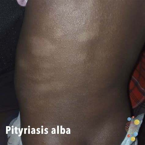 Pityriasis Alba Skin Deep