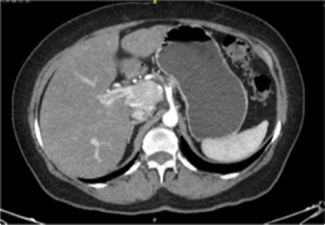 A Ct Revealing A Lymph Node Between The Portal Vein And The Inferior
