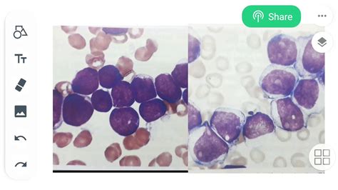 Myeloblast Vs Lymphoblast Learn The Difference Bw Them Youtube