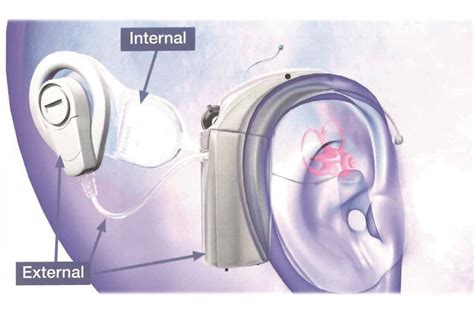 Best Cochlear Implant Centers
