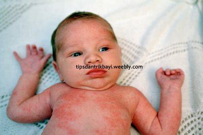 Bintik merah terbentuk akibat adanya pembuluh darah yang rusak tepat dibawah kulit. Bintik Merah pada Kulit Bayi disertai Demam - Tips dan ...