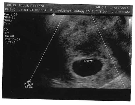 Ultrasound Update 7 Weeks Of Pregnancy