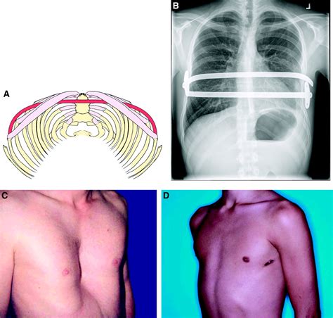 Current Management Of Pectus Excavatum A Review And Update Of Therapy